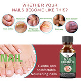 Anti Fungal Nail Fungus Treatment For Toe and Natural Cure Finger Nail Infection 10ml